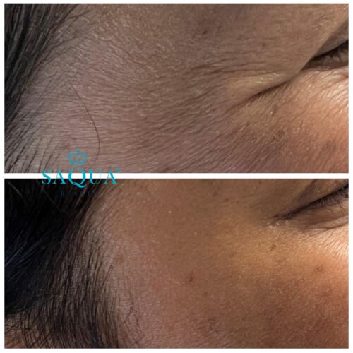 Anti-Wrinkle-Injections-1 (1)