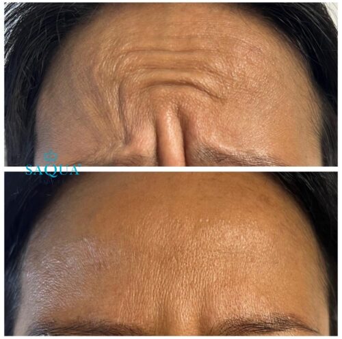 Anti-Wrinkle-Injections-1 (2)