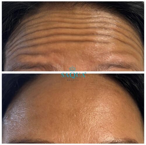 Anti-Wrinkle-Injections-1 (3)