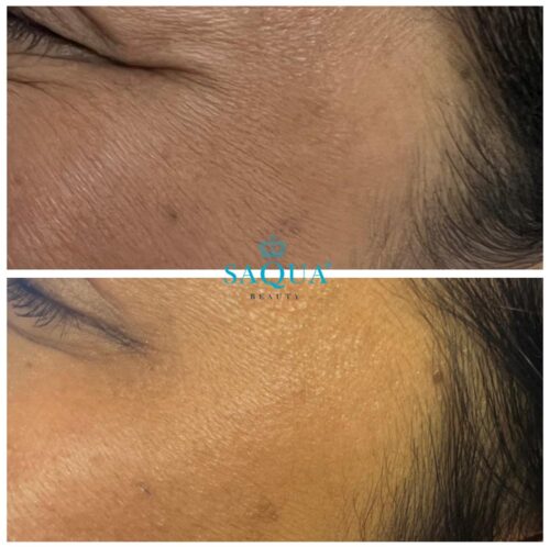 Anti-Wrinkle-Injections-1 (4)