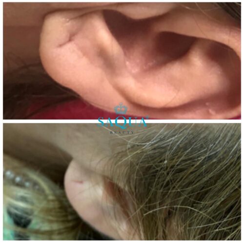 Ear-Lobe-Filler (1)