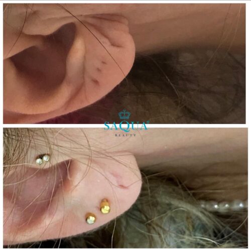 Ear-Lobe-Filler (2)