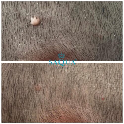 Fibroblast-skin-tag-removal (1)
