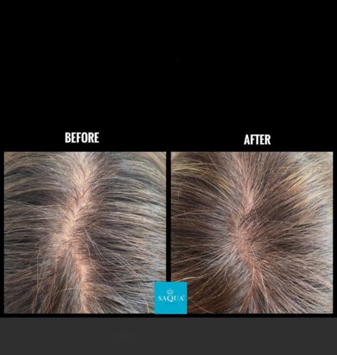 Hair-Mesotherapy (15)